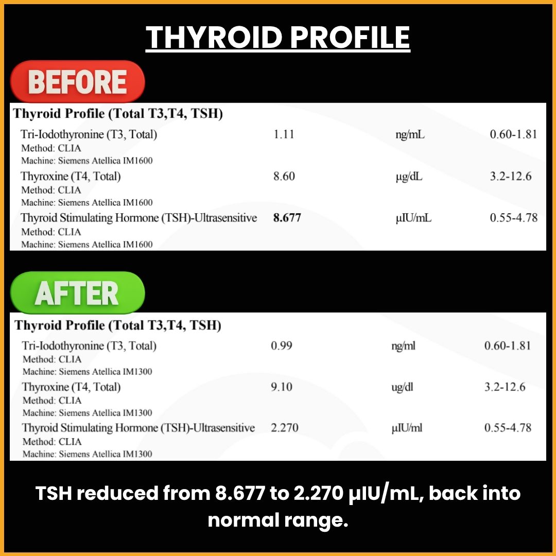 Thyroid Profile Transformation